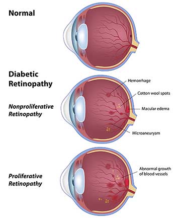 Diabetic Eye Care in Aventura