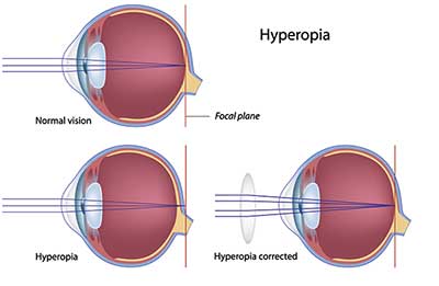 Ophthalmologist in Aventura