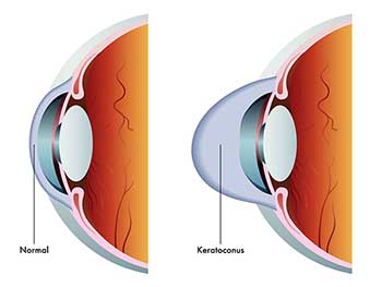 Keratoconus in Hollywood FL