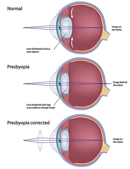 Presbyopia Eye Doctor in Hollywood FL