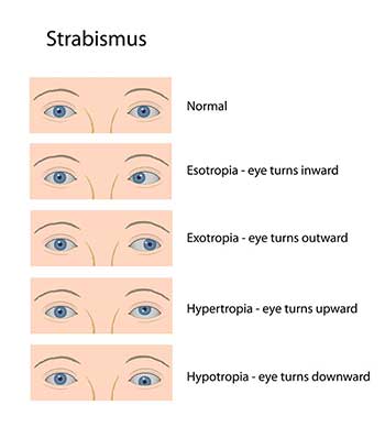 Strabismus in Hollywood FL